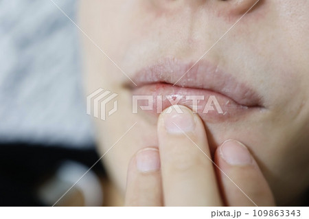 20代女性の乾燥したくちびる　一部出血が見られる 109863343