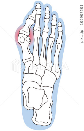 外反母趾　段階　足の骨　骨格図 109907501