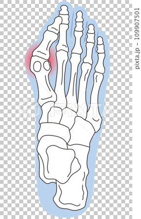 外反母趾　段階　足の骨　骨格図 109907501