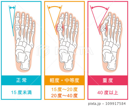 外反母趾　段階　足の骨　骨格図 109917584