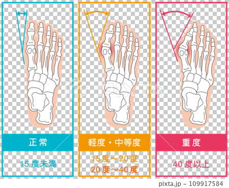 外反母趾　段階　足の骨　骨格図 109917584