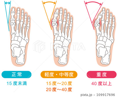 外反母趾 段階 足の骨 骨格図 外反母趾 段階 足の骨 骨格図 109917696