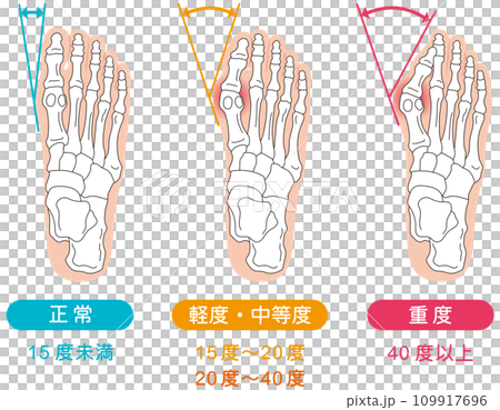外反母趾 段階 足の骨 骨格図 外反母趾 段階 足の骨 骨格図 109917696