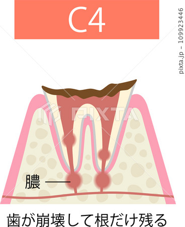 虫歯　C4 歯が崩壊し歯根だけ残る 109923446