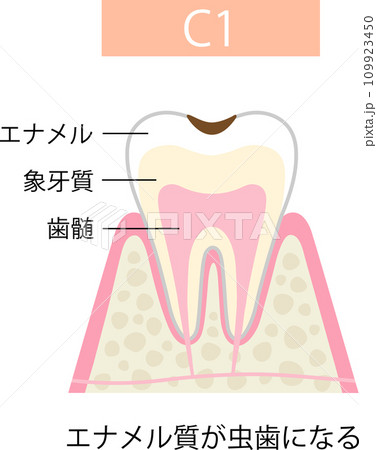 C1　エナメル質の虫歯 109923450