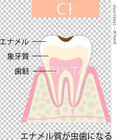 C1 Enamel caries 109923450
