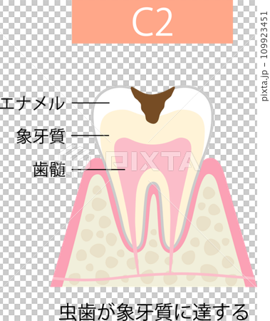 C 2 牙本質齲齒 109923451