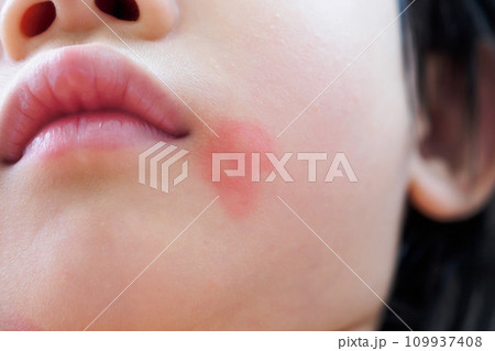 little asian girl skin rash and allergy with red spot cause by mosquito bite at face little asian girl skin rash and allergy with red spot cause by mosquito bite at face 109937408