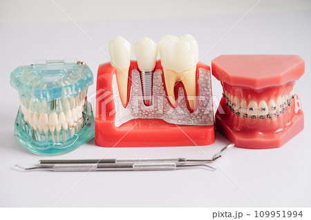 Dental implant, artificial tooth roots into jaw, root canal of dental treatment, gum disease, teeth model for dentist studying about dentistry. Dental implant, artificial tooth roots into jaw, root canal of dental treatment, gum disease, teeth model for dentist studying about dentistry. 109951994