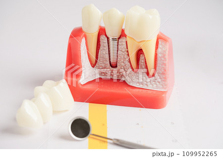 Dental implant, artificial tooth roots into jaw, root canal of dental treatment, gum disease, teeth model for dentist studying about dentistry. 109952265