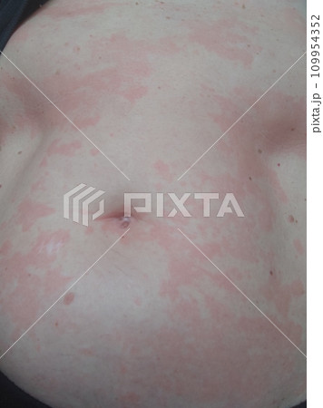 Female abdomen affected by a severe allergic reaction, dermatitis Female abdomen affected by a severe allergic reaction, dermatitis 109954352