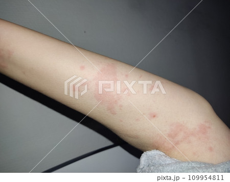 Female body affected by a severe allergic reaction, dermatitis Female body affected by a severe allergic reaction, dermatitis 109954811