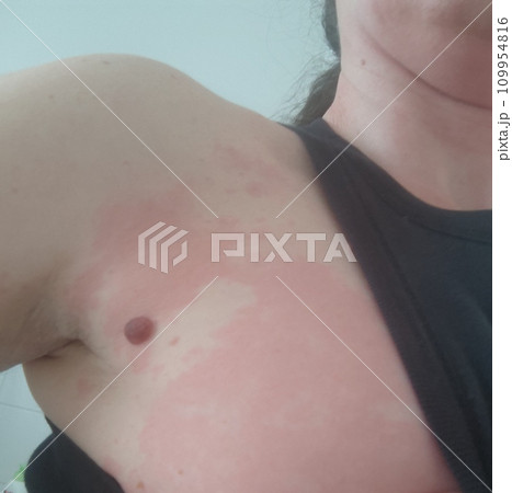 Female body affected by a severe allergic reaction, dermatitis Female body affected by a severe allergic reaction, dermatitis 109954816