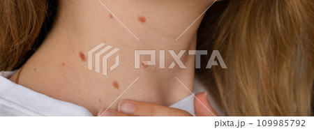 Unrecognizable woman showing her Birthmarks on neck skin Close up detail of the bare skin Banner Sun Exposure effect on skin, Health Effects of UV Radiation Woman with birthmarks Pigmentation 109985792
