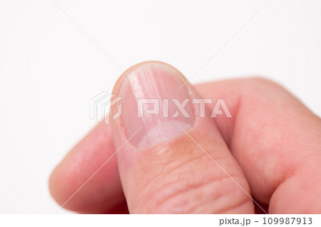 爪に縦の筋（爪甲縦条） 109987913