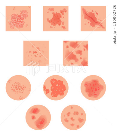 Different types of psoriasis vector set. Part of patients skin with dermatitis, inflammation, red rash and other skin problems. Cartoon illustration for disease concept 110002726
