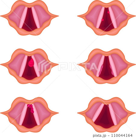 声帯 病気 構造 種類 イラスト 声帯 病気 構造 種類 イラスト 110044164