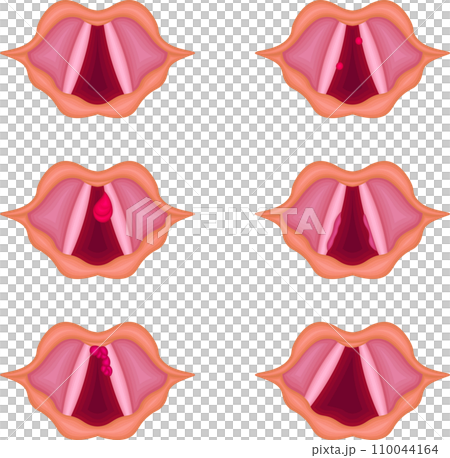 声帯 病気 構造 種類 イラスト 声帯 病気 構造 種類 イラスト 110044164