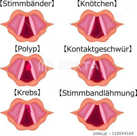 声帯 病気 構造 種類 イラスト ドイツ語 声帯 病気 構造 種類 イラスト ドイツ語 110044184