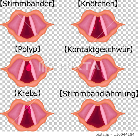 声帯 病気 構造 種類 イラスト ドイツ語 声帯 病気 構造 種類 イラスト ドイツ語 110044184