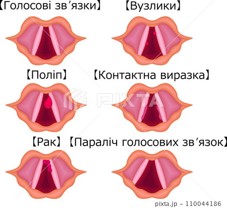声帯 病気 構造 種類 イラスト ウクライナ語 声帯 病気 構造 種類 イラスト ウクライナ語 110044186