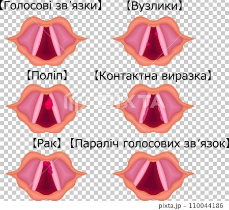 声帯 病気 構造 種類 イラスト ウクライナ語 声帯 病気 構造 種類 イラスト ウクライナ語 110044186