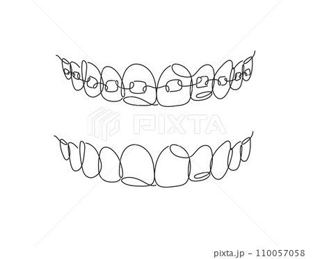 Jaws with and without braces installed flat line Jaws with and without braces installed flat line 110057058