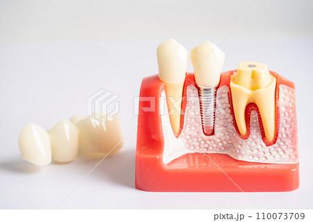 Dental implant, artificial tooth roots into jaw, root canal of dental treatment, gum disease, teeth model for dentist studying about dentistry. Dental implant, artificial tooth roots into jaw, root canal of dental treatment, gum disease, teeth model for dentist studying about dentistry. 110073709