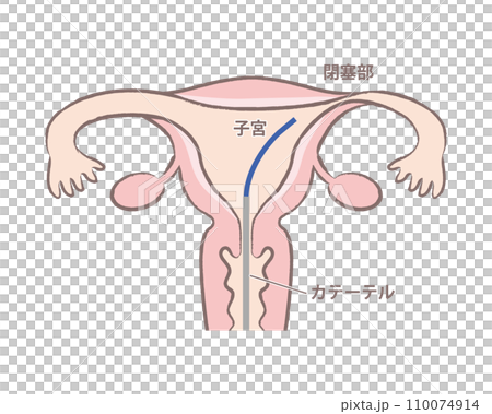 輸卵管鏡輸卵管成形術子宮圖 110074914