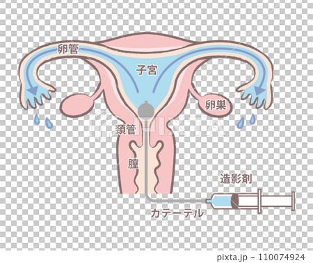 Salpingography examination - Illustration of the uterus with good passage of the fallopian tubes - Explanation diagram - text included 110074924