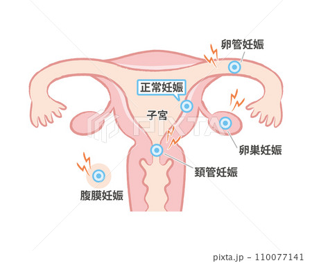 子宮外妊娠 子宮のイラスト図 卵管、卵巣、頚管、腹膜 子宮外妊娠 子宮のイラスト図 卵管、卵巣、頚管、腹膜 110077141