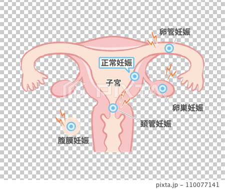 子宮外妊娠 子宮のイラスト図 卵管、卵巣、頚管、腹膜 子宮外妊娠 子宮のイラスト図 卵管、卵巣、頚管、腹膜 110077141