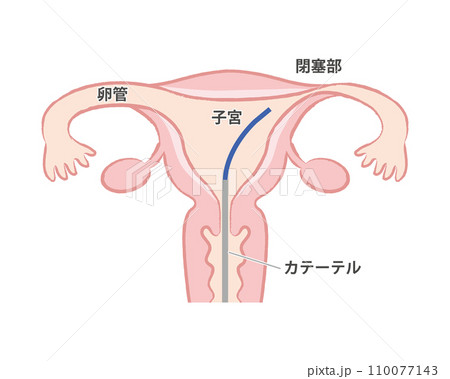卵管鏡下卵管形成術 子宮のイラスト 卵管鏡下卵管形成術 子宮のイラスト 110077143