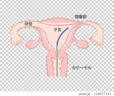 卵管鏡下卵管形成術 子宮のイラスト 卵管鏡下卵管形成術 子宮のイラスト 110077143
