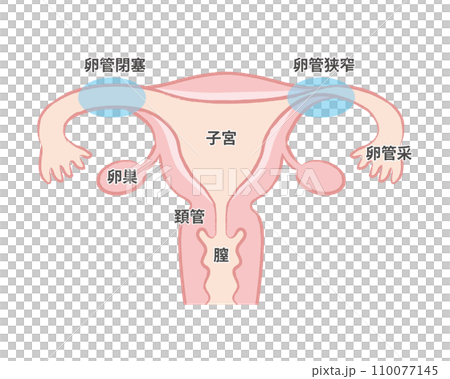 Fallopian tube obstruction Fallopian tube stenosis Fallopian tube blockage Uterus illustration explanatory diagram Fallopian tube obstruction Fallopian tube stenosis Fallopian tube blockage Uterus illustration explanatory diagram 110077145