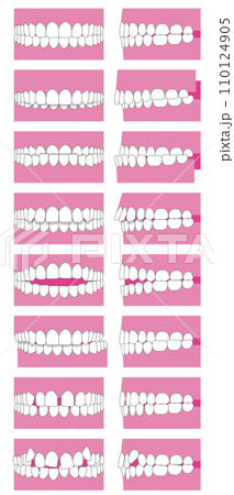 歯並び、歯列の不正咬合の種類。正面と横のベクターイラスト 歯並び、歯列の不正咬合の種類。正面と横のベクターイラスト 110124905