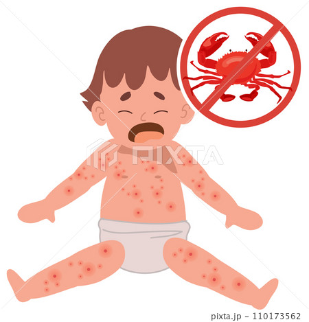 Allergic Reactions in Infants. baby with skin...のイラスト素材 [110173562] - PIXTA
