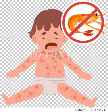 Allergic Reactions in Infants. baby with skin...のイラスト素材 [110173571] - PIXTA