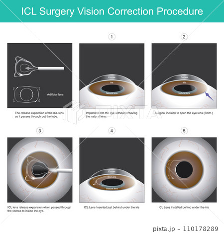 ICL Surgery Vision Correction Procedure. A new eye lens that can be implanted into the eye without removing the natural lens. 110178289