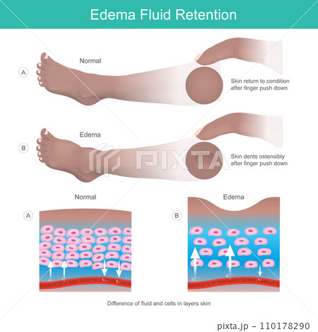Edema Fluid Retention. Dents on skin after finger push down to leg result of Edema symptom. 110178290