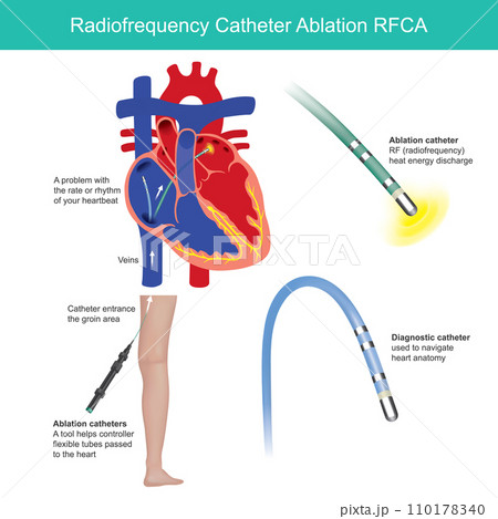 Radio frequency Catheter Ablation. Medical procedure is used to help control the heart rhythm problems such as atrial fibrillation. 110178340