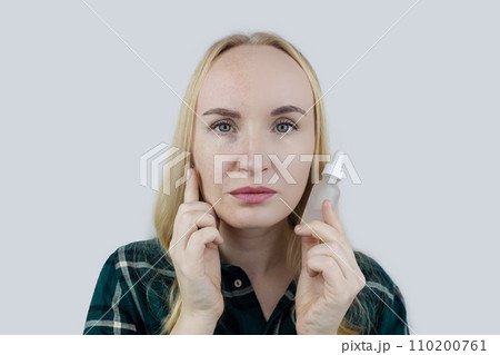 Vitamin A, Retinol, Niacinamide, Vitamin C. Girl smears her face with antioxidant anti-wrinkle cream. Anti-aging and facial rejuvenation agent. Before and after. Visual result. Acne treatment Vitamin A, Retinol, Niacinamide, Vitamin C. Girl smears her face with antioxidant anti-wrinkle cream. Anti-aging and facial rejuvenation agent. Before and after. Visual result. Acne treatment 110200761