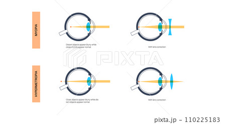 Astigmatism eye disease 110225183