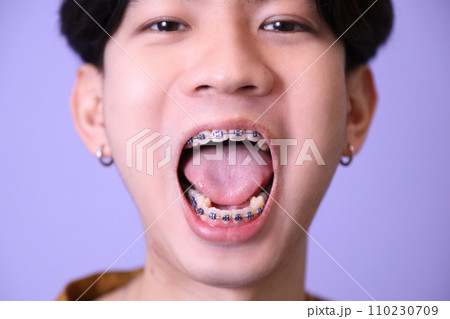 Man with Braces Man with Braces 110230709