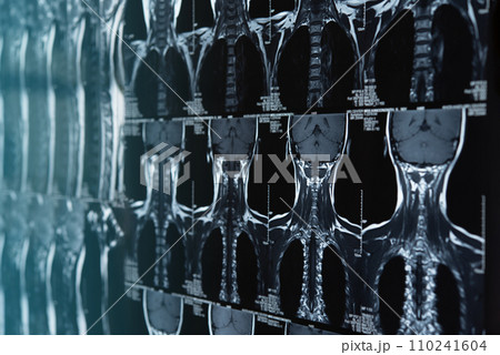cervical spine x-ray film cervical spine x-ray film 110241604