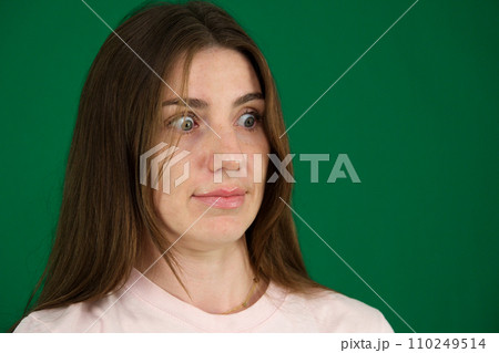 Macro closeup of young woman face with Grave's disease hyperthyroidism symptoms of ophthalmopathy bulging eyes proptosis edema Macro closeup of young woman face with Grave's disease hyperthyroidism symptoms of ophthalmopathy bulging eyes proptosis edema 110249514