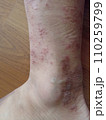 rash eczema dermatitis  on leg. inflammation of skin 110259799