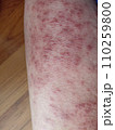 rash eczema dermatitis  on leg. inflammation of skin 110259800