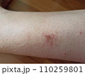 rash eczema dermatitis  on leg. inflammation of skin 110259801