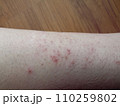 rash eczema dermatitis  on leg. inflammation of skin 110259802